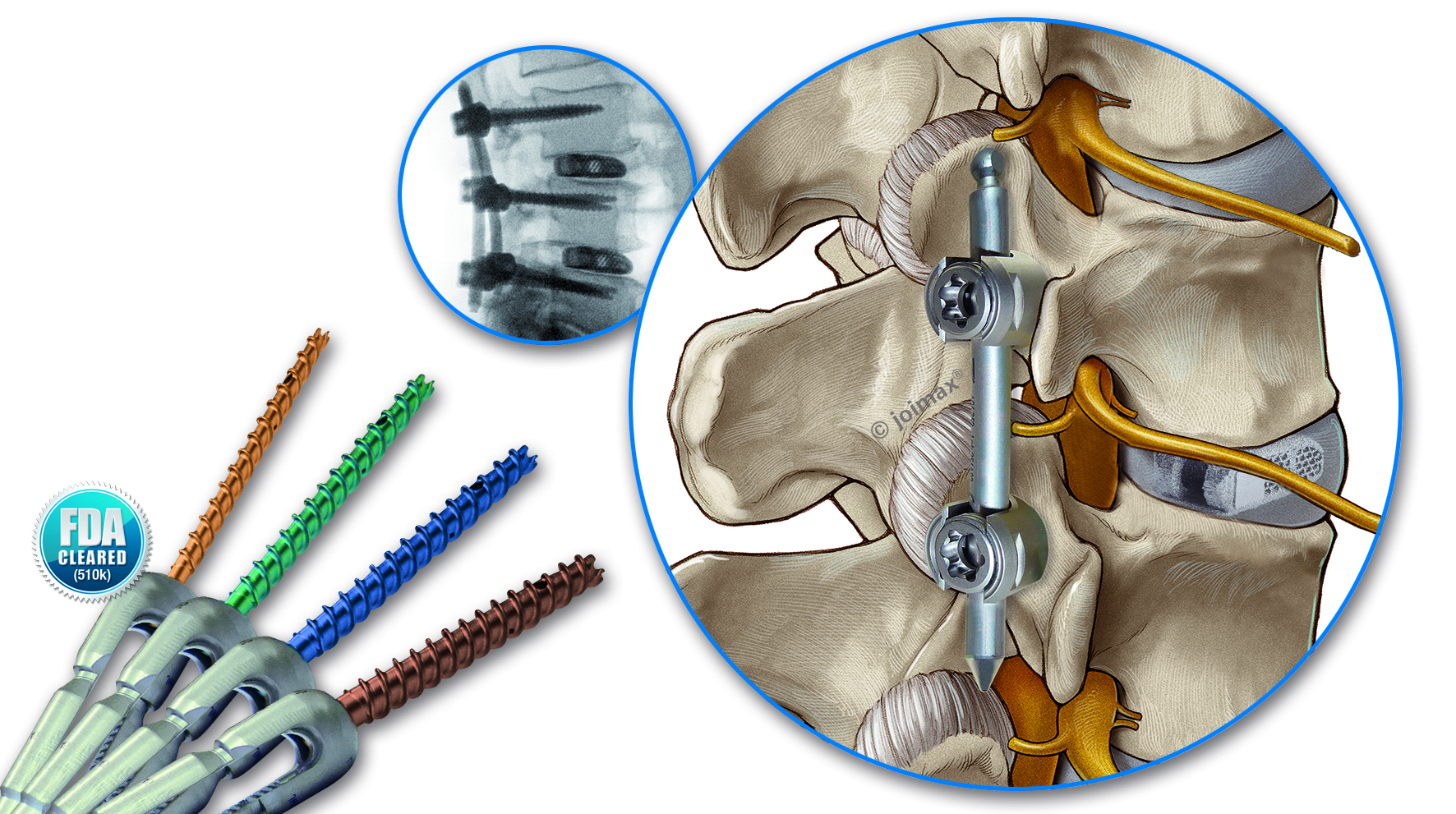 joimax Percusys Pedicle Screw Rod System