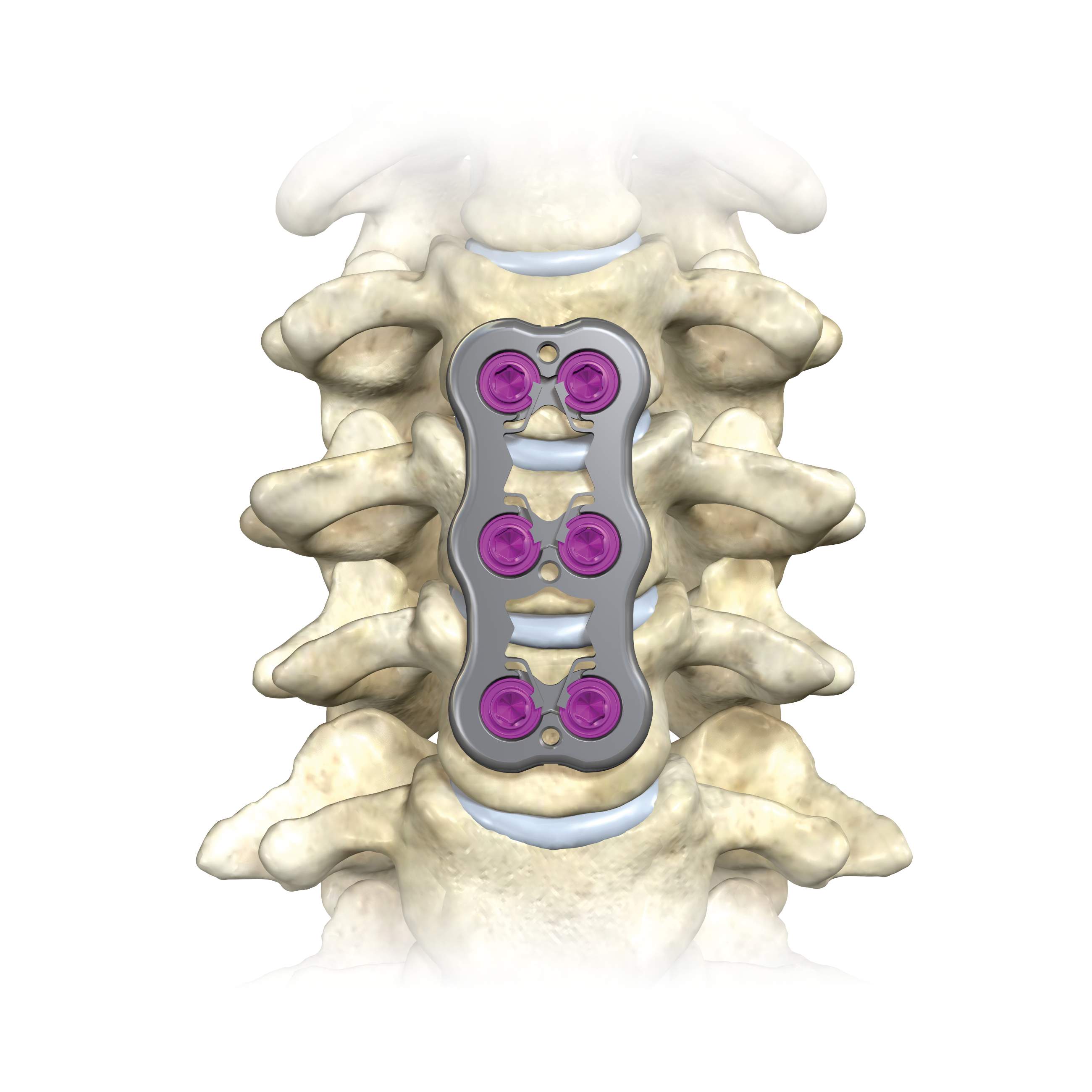 ARANAX Cervical Plating System