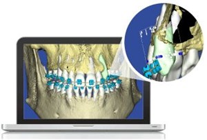 Digital 3D Orthodontic Model Bone