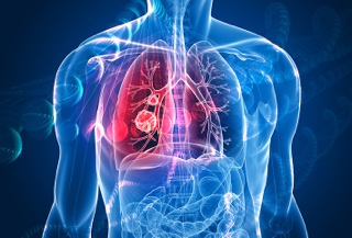 First Reported Case of Six-Year Survival for Patient with Metastatic Lung Cancer
