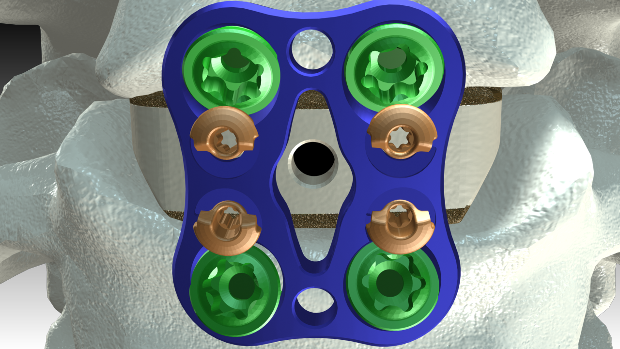 Revision_Screw_fourscrewApngA