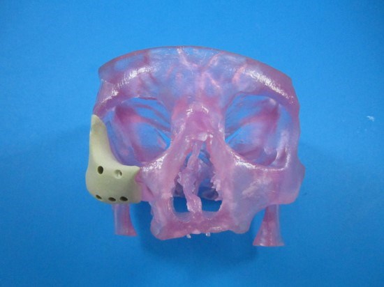 OPM's 3D Printed OsteoFab(R) Patient-Specific Facial Device