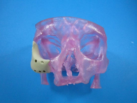 OPM's 3D Printed OsteoFab(R) Patient-Specific Facial Device
