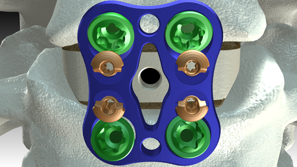 Revision_Screw_fourscrewApngA